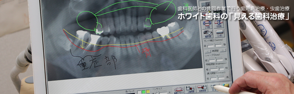 歯周病・歯槽のう漏・歯肉炎　鈴鹿市の歯医者さん　ホワイト歯科